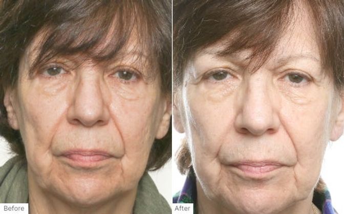 After using ProLuxe Reblancing Shampoo
