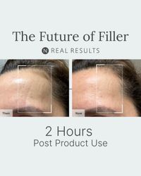 NEW! Neo-FILLER Lift + Fill Corrective Elixir