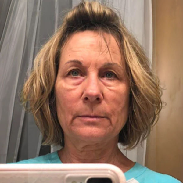 Before — Lisa R.