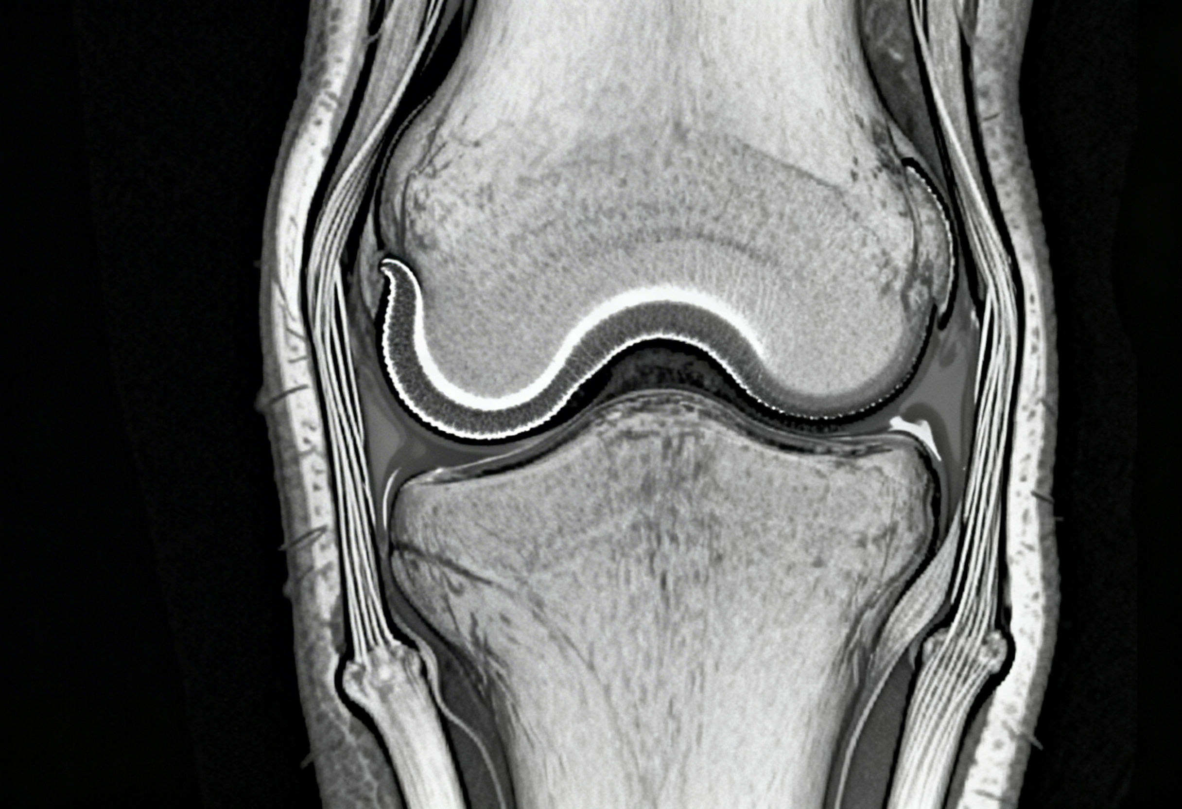 Meniscus supported by surrounding knee ligaments