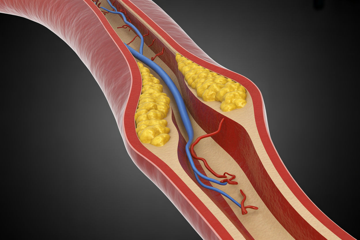 Peripheral artery disease showing plaque narrowing the arteries of the leg