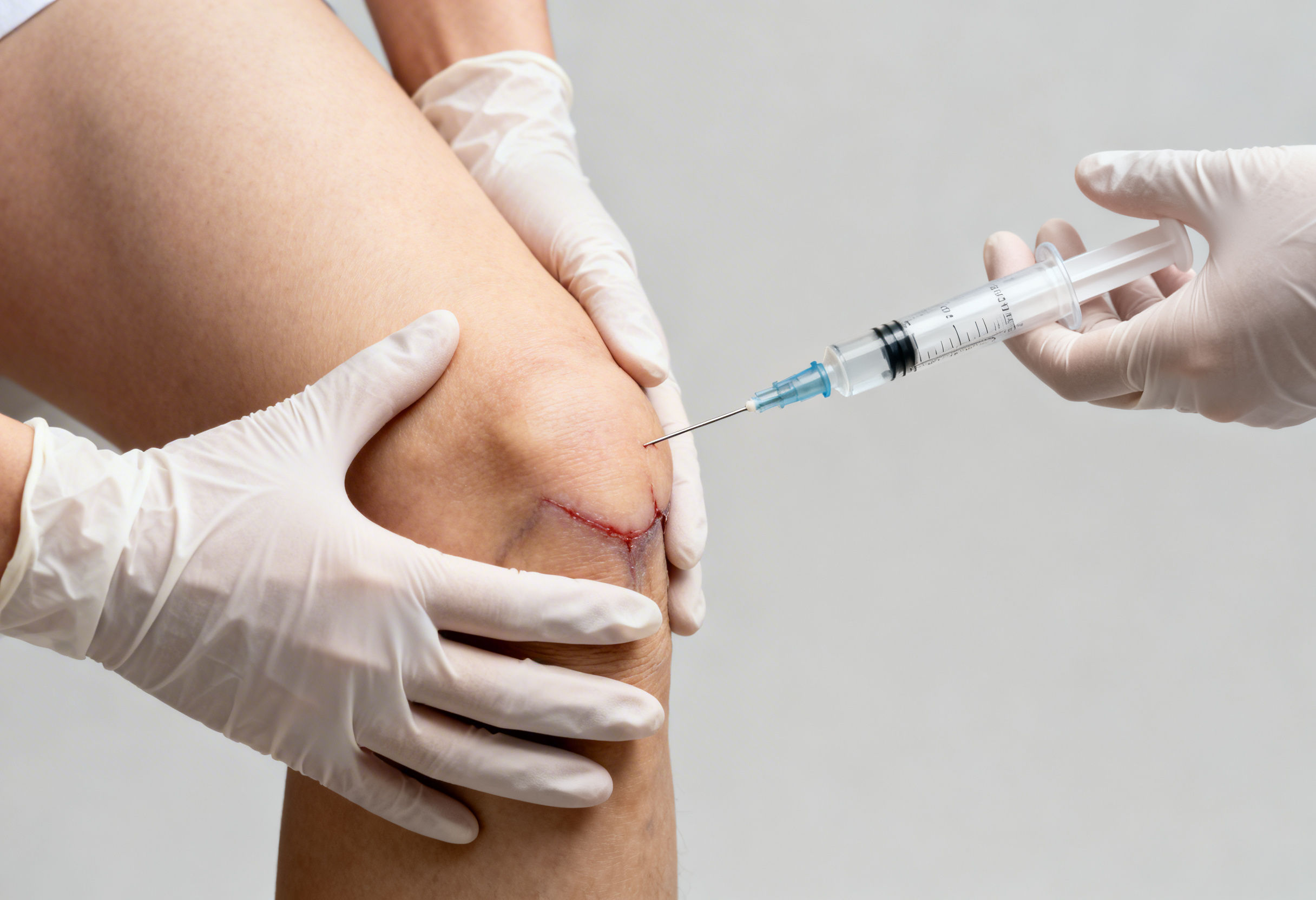 Prolozone therapy injection for arthritis pain treatment