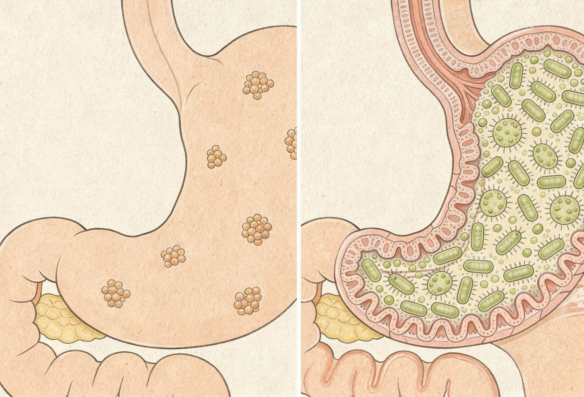 small intestine showing normal digestion versus bacterial overgrowth causing SIBO
