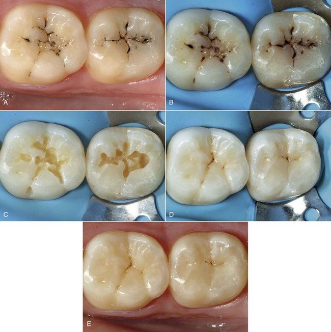 Modern denture solutions