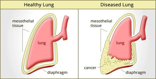 types of lung cancer mesothelioma