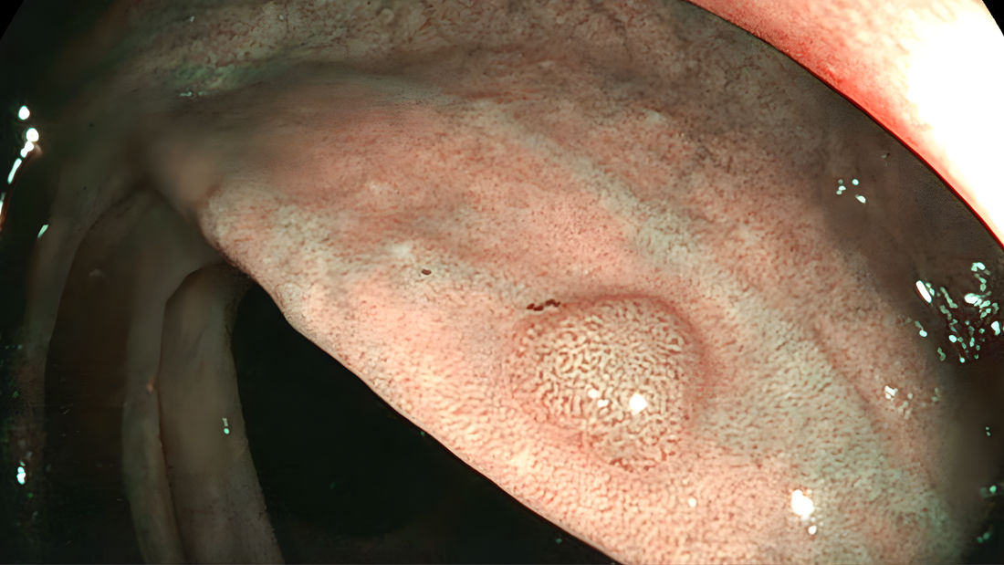 Polyp