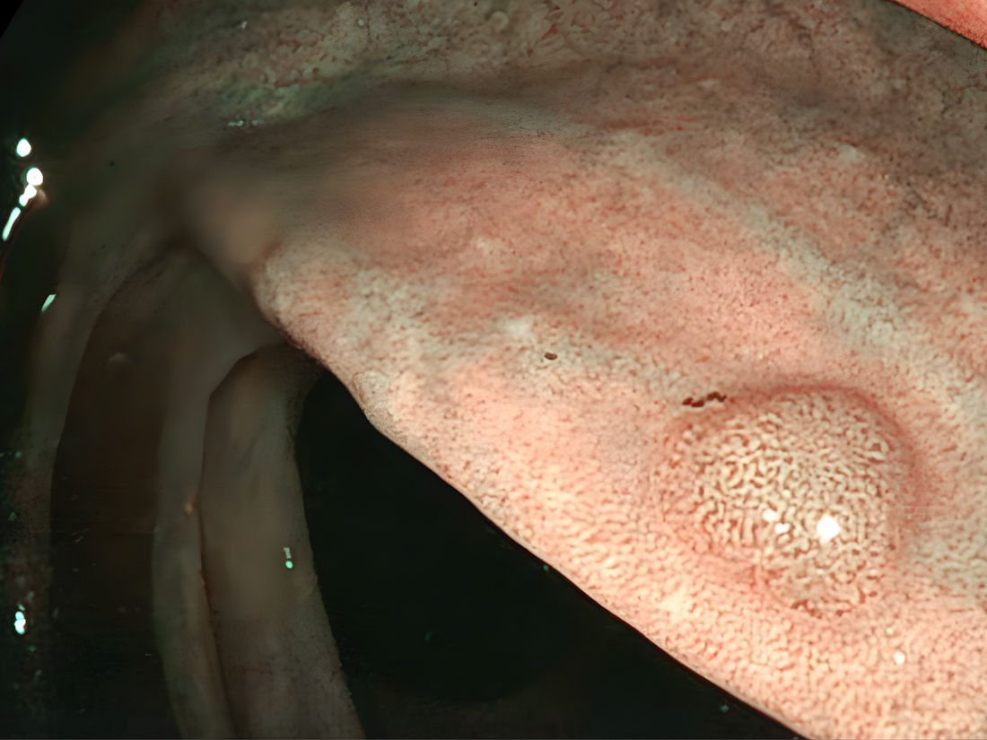 Polyp