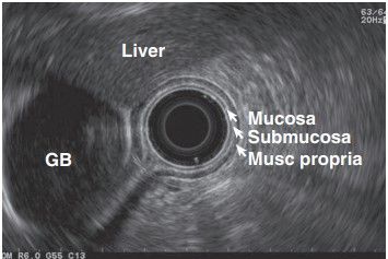 Endoscopic Ultrasonography in the Stomach: Precision in Gastric Imaging