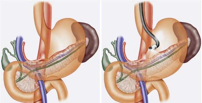 Revolutionizing Gastrointestinal Diagnostics: Endoscopic Ultrasonography in the Pancreas, Bile Duct, and Liver