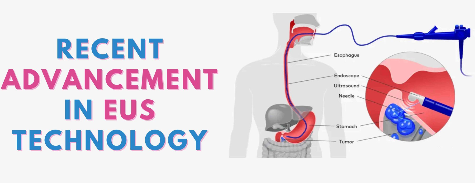 New Techniques in EUS: Real-Time Elastography, Contrast-Enhanced EUS, and Fusion Imaging