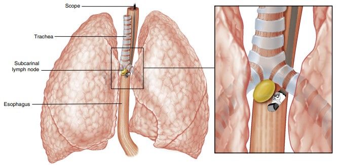 EUS and EBUS: Enhancing Non–Small Cell Lung Cancer Staging