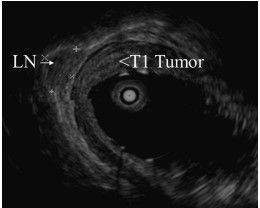 Enhancing Esophageal and Gastric Cancer Care with Endoscopic Ultrasound