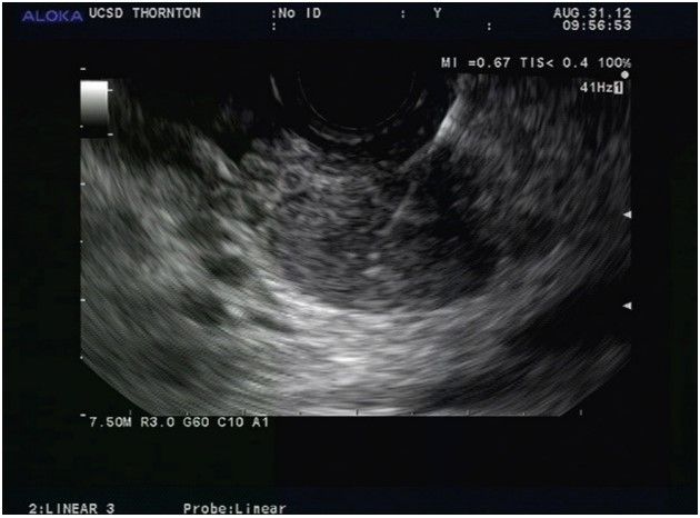 Endoscopic Ultrasonography in Evaluating Posterior Mediastinal Lesions