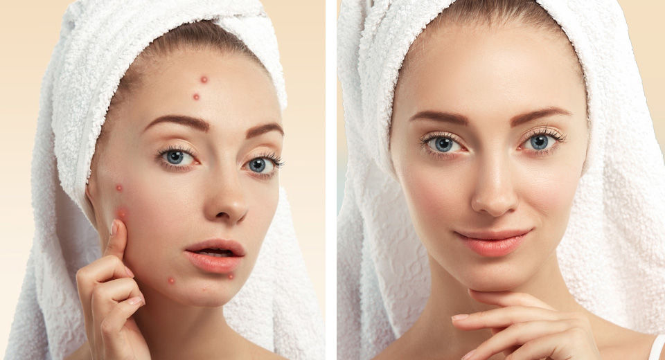 5 Best Pimple Patches Under $15 That Actually Work Well