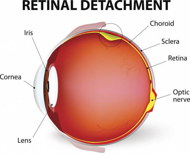 retina detachment