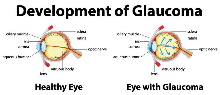 Glaucoma