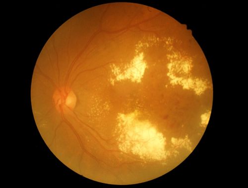 Diabetes and the Eyes can result in Diabetic Retinopathy