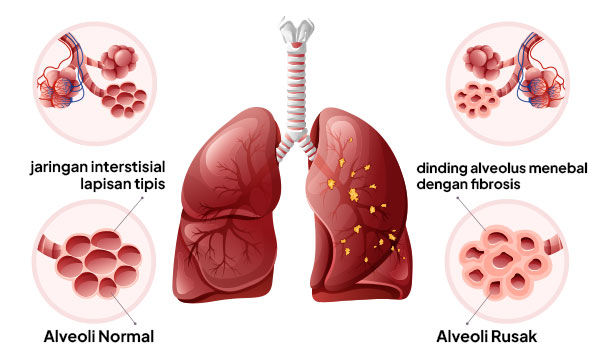 Gambar Kondisi Fibrosis Paru