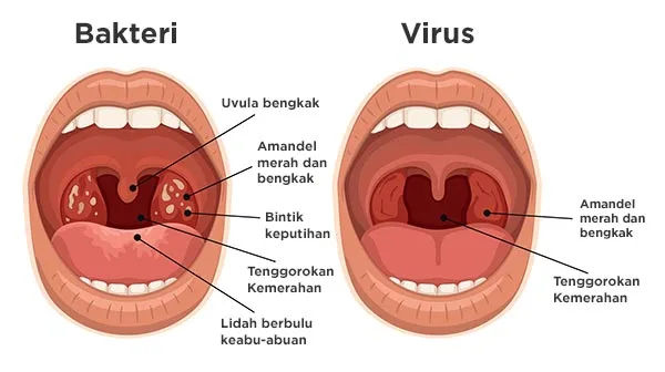 Gambar Radang Amandel - Tonsilitis