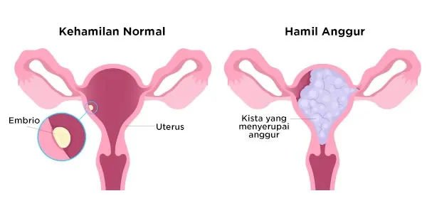 Visualisasi Hamil Anggur