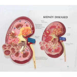 Kidney Disease Anatomical Model