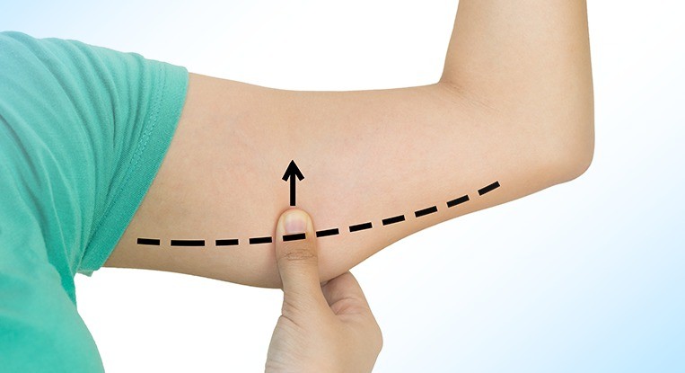 Lifting de braço: como é feita a cirurgia? - Blog Master Health