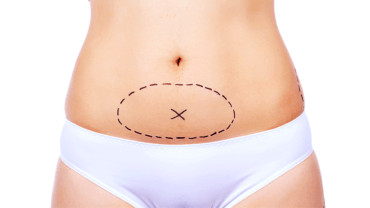 Miniabdominoplastia