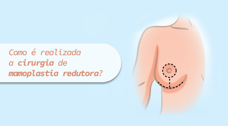 Mamoplastia Redutora – O que acontece durante a cirurgia