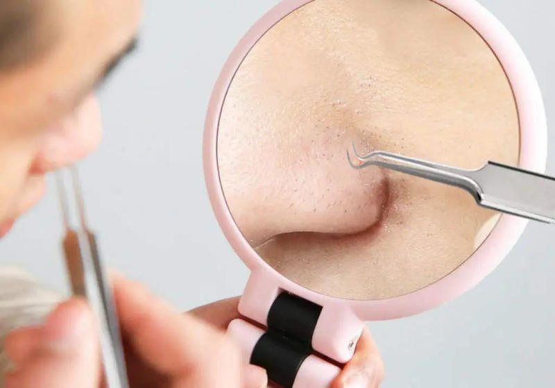 Description Picture 5 of item5 PCS Blackhead Remover Comedones Extractor Acne Removal Kit for Blemish, Whitehead Popping, Zit Removing for Nose Face Tools