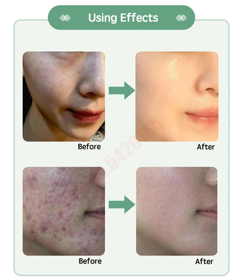 Description Picture 3 of item90% High Tingling Sensation 50% Sponge Microneedle Inverse Age Lyophilized Powder Blue 9opper Peptide Lyophilized Powder