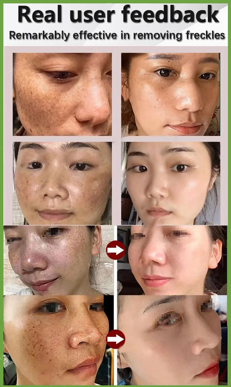 Description Picture 6 of itemFreckles Removal Essence Remove Facial Spots Skin Dark Spot Remove Melasma Spots Sunspots Whitening And Freckle Removing oil