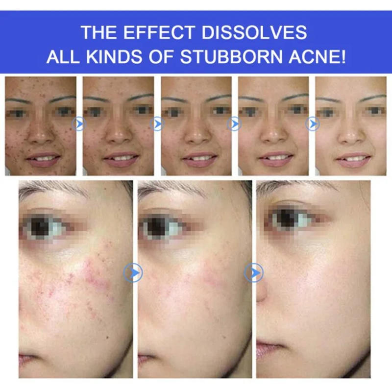 Description Picture 5 of itemNew Effective Acne Removal Cream Clears Blemish Pimple Remover Spot Safe Gentle Remove Acne Acne Cream For Clearing Severe Acne