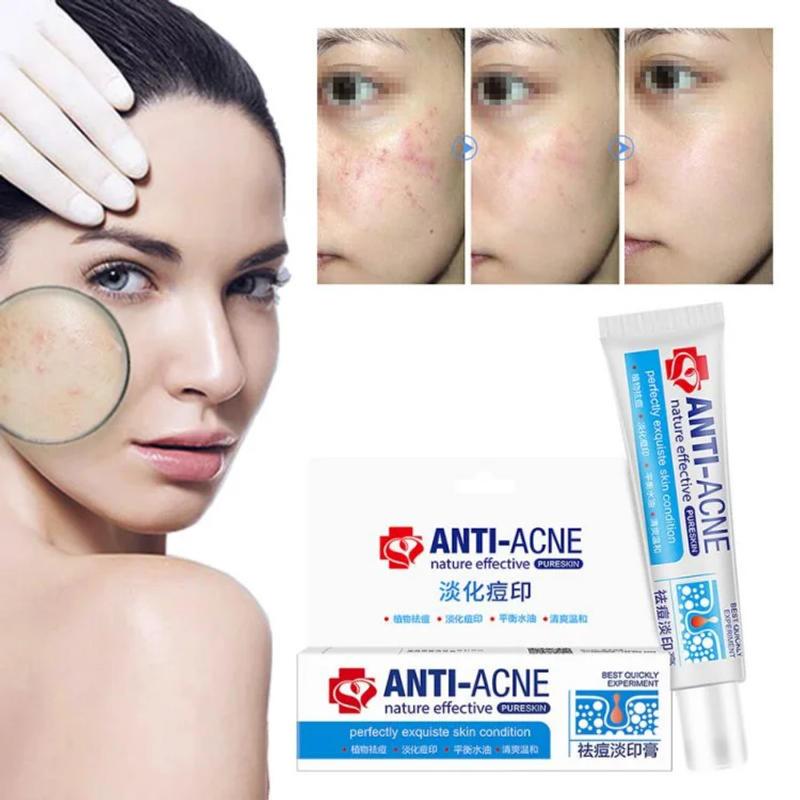 Description Picture 4 of itemNew Effective Acne Removal Cream Clears Blemish Pimple Remover Spot Safe Gentle Remove Acne Acne Cream For Clearing Severe Acne