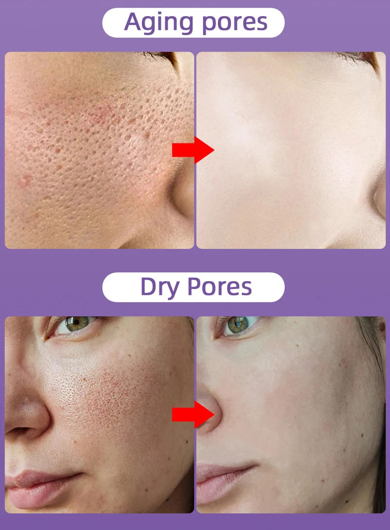 Description Picture 4 of itemPore Shrinking Skin Care Facial Essence Large Pore Remover Relieving Moisturize Face Oil Control Firming Serum Korean Cosmetics