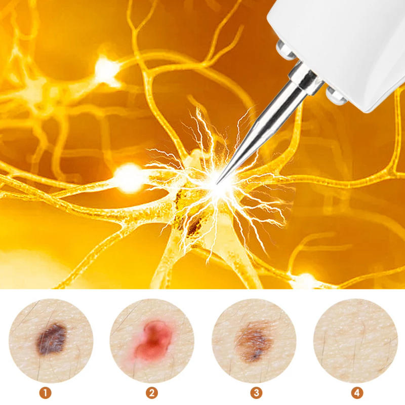 Description Picture 5 of itemMole Removing Machine Electric Beauty Spot Pen Beauty Salon Special Remove Mole Fat Grain Warts Skin Care Skin Tag Remover