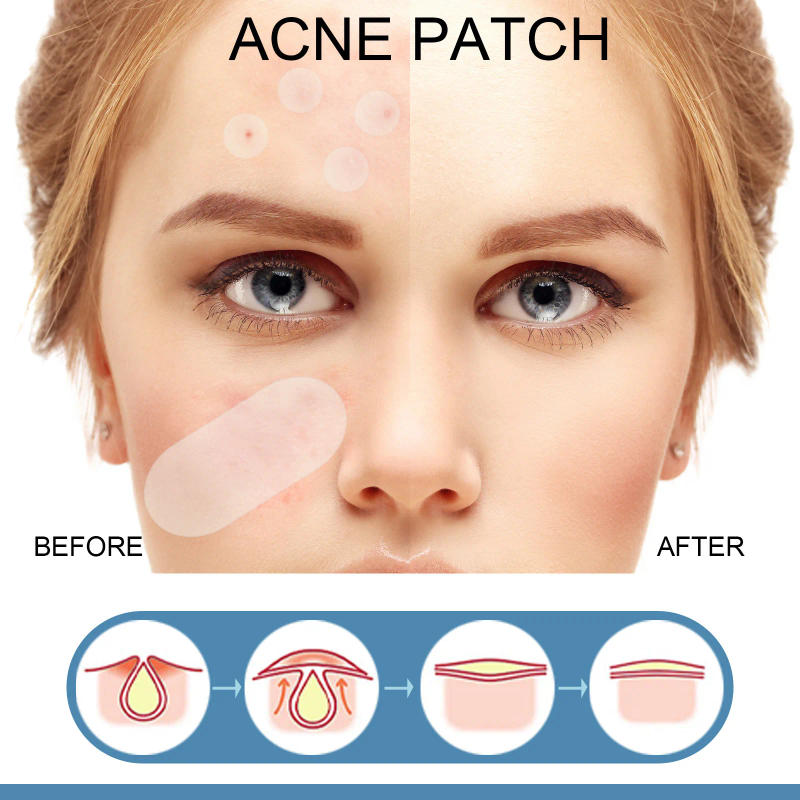 Description Picture 5 of item36/80pcs Acne Pimple Sticker Invisible Hydrocolloid Acne Removal Treatment Patch Waterproof Black Head Remover Facial Skin Care