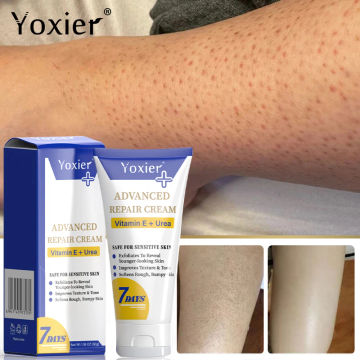 Vitamin E Repair Cream Removal Chicken Skin Goose Bumps Improves Dry Rough Treatment Keratosis Pilaris Moisturizing Smooth Skin