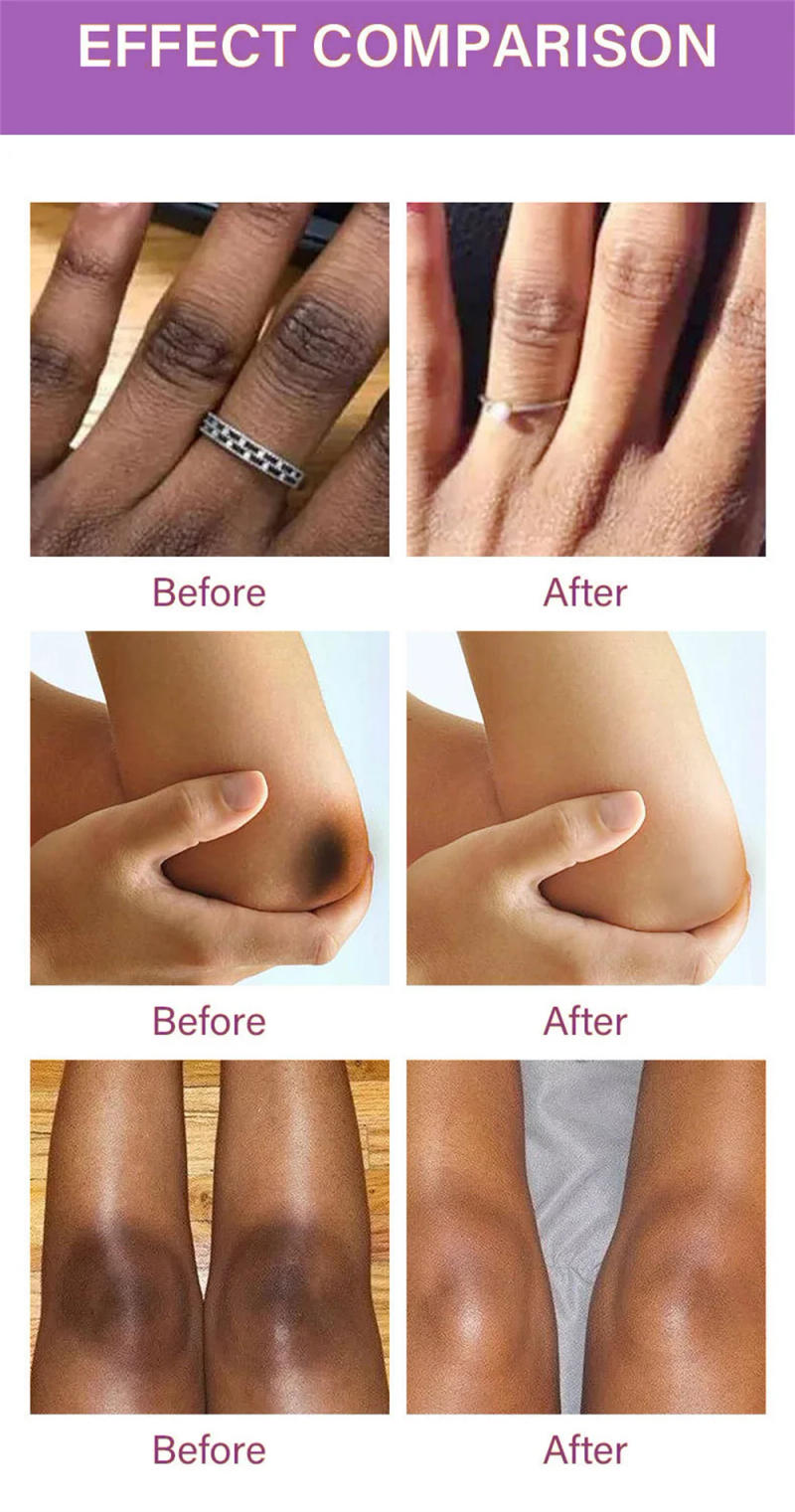 Description Picture 3 of itemDark Knuckles Fast Whitening Serum Pigmentation Correctors for Black Skin Hand Knuckle Elbows Knee Intense Stains Remover Serum