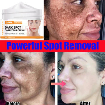 Dark Spot Remover Face Cream Remove Pigments Melasma Melanin Correcting Whitening Freckle Cream Brighten Smooth Beauty Skin Care