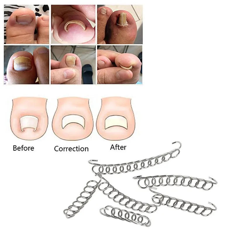 Description Picture 4 of itemTcare 1Set Fixer Pedicure Recover Ingrown Toenail Correction Wire Fixer Ingrown Toe Corrector Pedicure Treatment Foot Care Tool