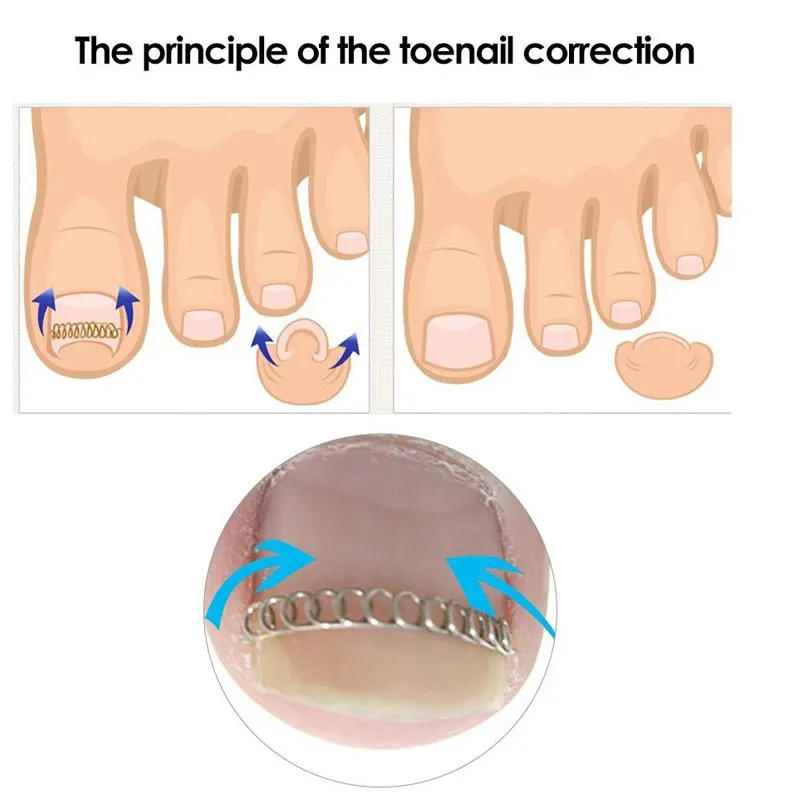 Description Picture 5 of itemTcare 1Set Fixer Pedicure Recover Ingrown Toenail Correction Wire Fixer Ingrown Toe Corrector Pedicure Treatment Foot Care Tool