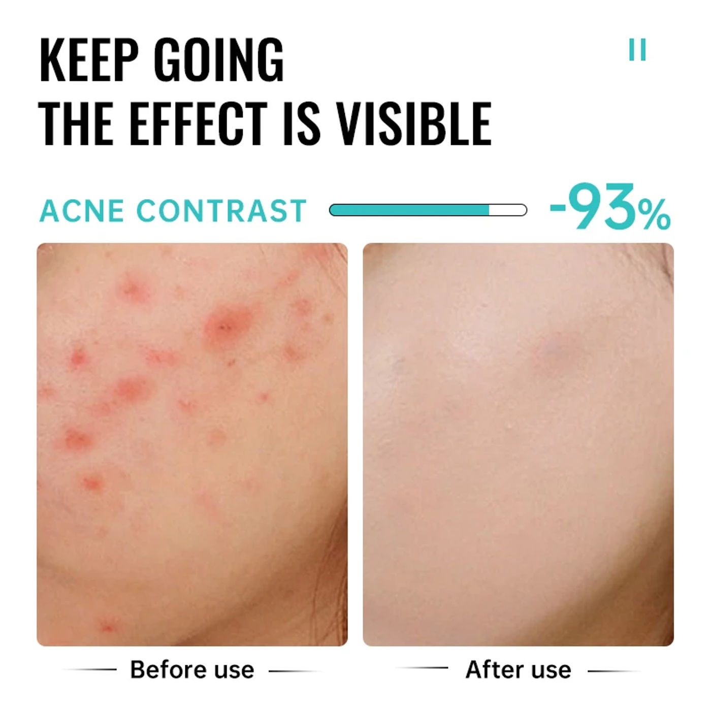 Description Picture 4 of itemAcidity Pore Shrink Face Serum Remove Blackhead Acne Spot Oil Control Moisturizing Repair Nourish Pores Firming Smooth Skin Care