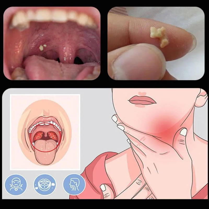 Description Picture 6 of itemTonsil Stone Remover Tool Suction Ball Manual Style Remover Mouth Cleaning Care Tool Ear Wax Tonsil Stone Remover Cleaning Tool