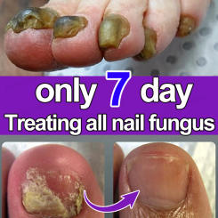 Nail fungus treatment essential oil, repair onychomycosis in 7 days