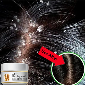 Fast Anti Dandruff Hair Treatment Scrub Itching Repair Scalp Cleaning Exfoliating Products Oil Control Antipruritic Hair Care