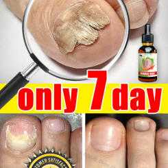 Eliminate Fungal Nails Permanently