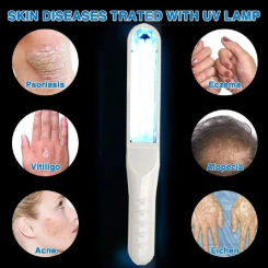 UVB 311nm ultraviolet lamp for the treatment of vitiligo  Uvb Phototherapy Narrow Uv Phototherapy Light Therapy Psoriasis For
