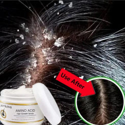 Instant Anti Exfoliating Scrub Remove Dandruff Anti Itching Treatment Seborrheic Scalp Oil Control Cleansing Repair Scalp Care