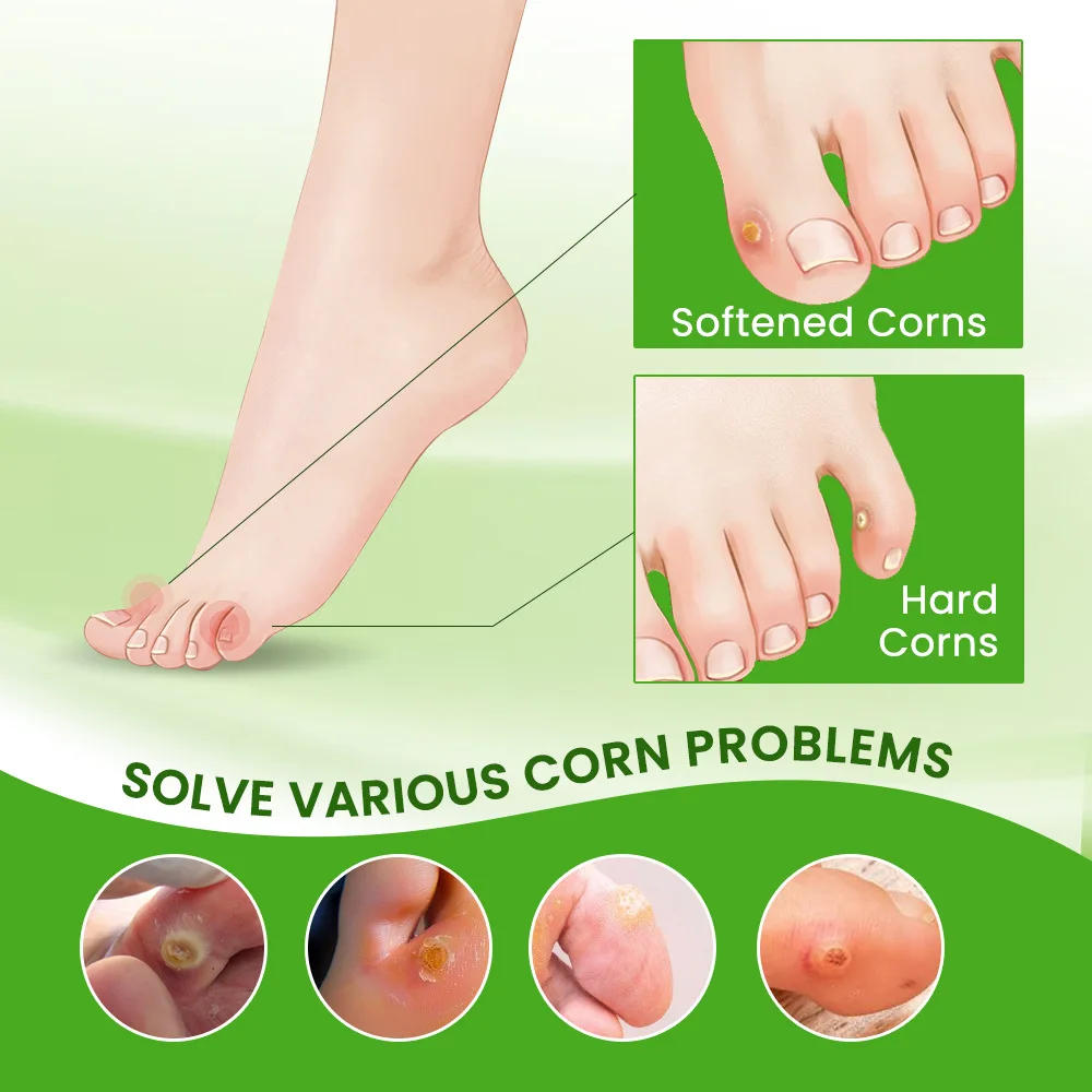 Description Picture 3 of itemFoot Corn Remover Cream Chicken Eye Skin Infection Treatment Ointment Feet Dead Skin Calluses Removal Tool Health Care 내성발톱