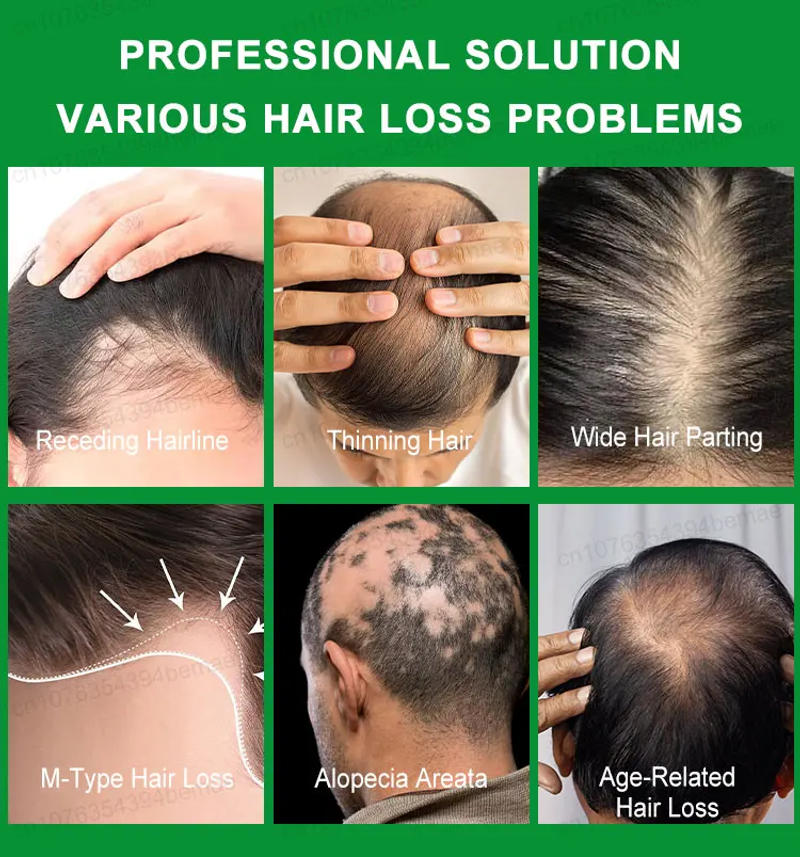 Description Picture 3 of itemHair Growth Oil Fast Hair Growth Effective Baldness Repair Hereditary Hair Loss Postpartum Hair Loss Seborrheic Hair Loss